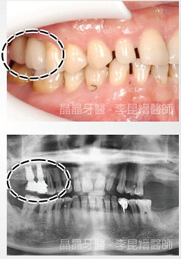 一般植牙案例1