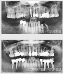 一般植牙案例10