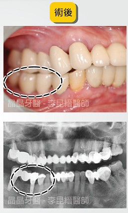 一般植牙案例分享2