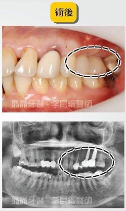 一般植牙術前術後案例4