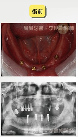 一般植牙案例5