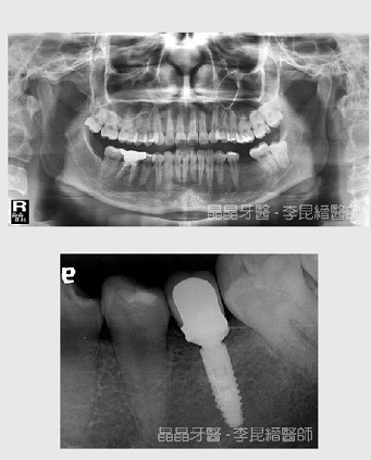 一般植牙案例6