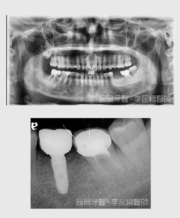 一般植牙案例7