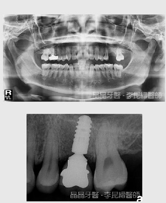 一般植牙案例8