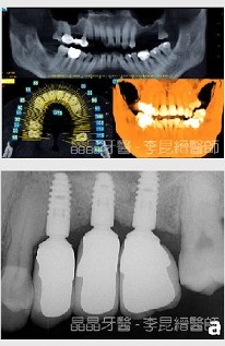 一般植牙案例9