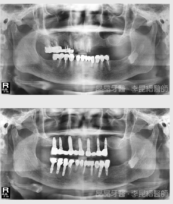 全口植牙案例1