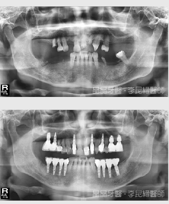 全口植牙案例2