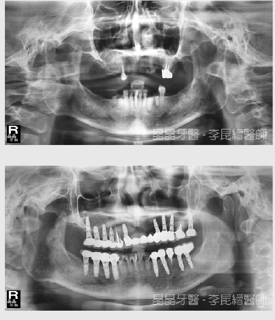 全口植牙案例分享3