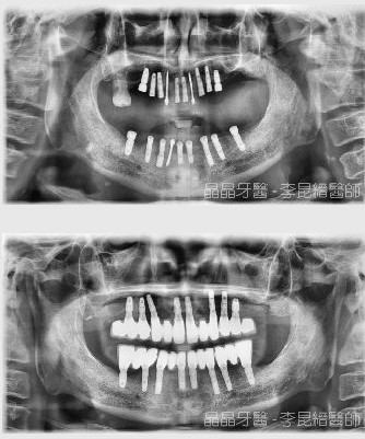 全口植牙案例4