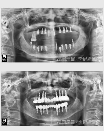 全口植牙術前術後5