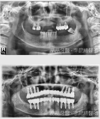 全口重建植牙案例1