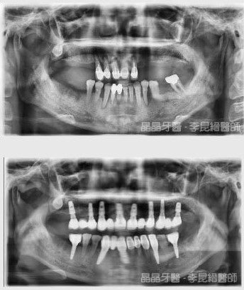 全口重建植牙案例2