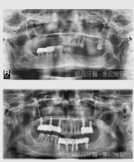 糖尿病植牙案例分享