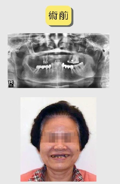 舒眠植牙案例2