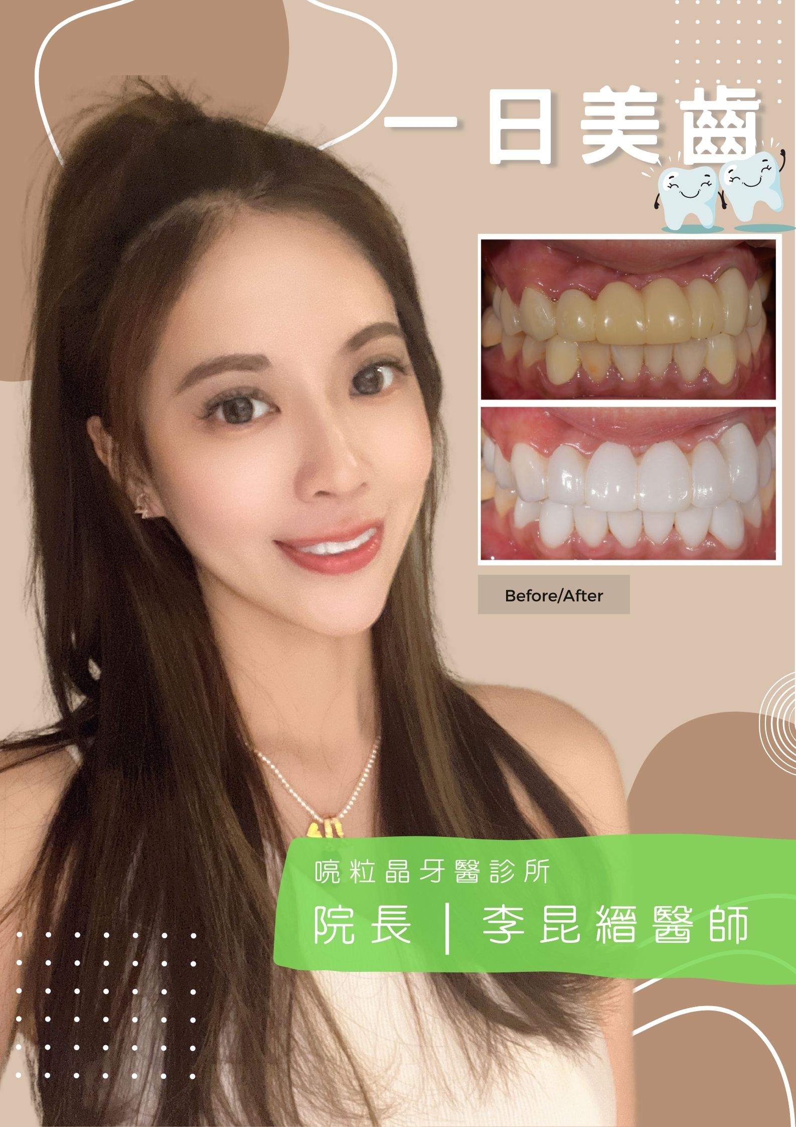 【牙齒美白案例-喨粒晶牙醫診所】一日美齒當日完成，美白前後對照圖