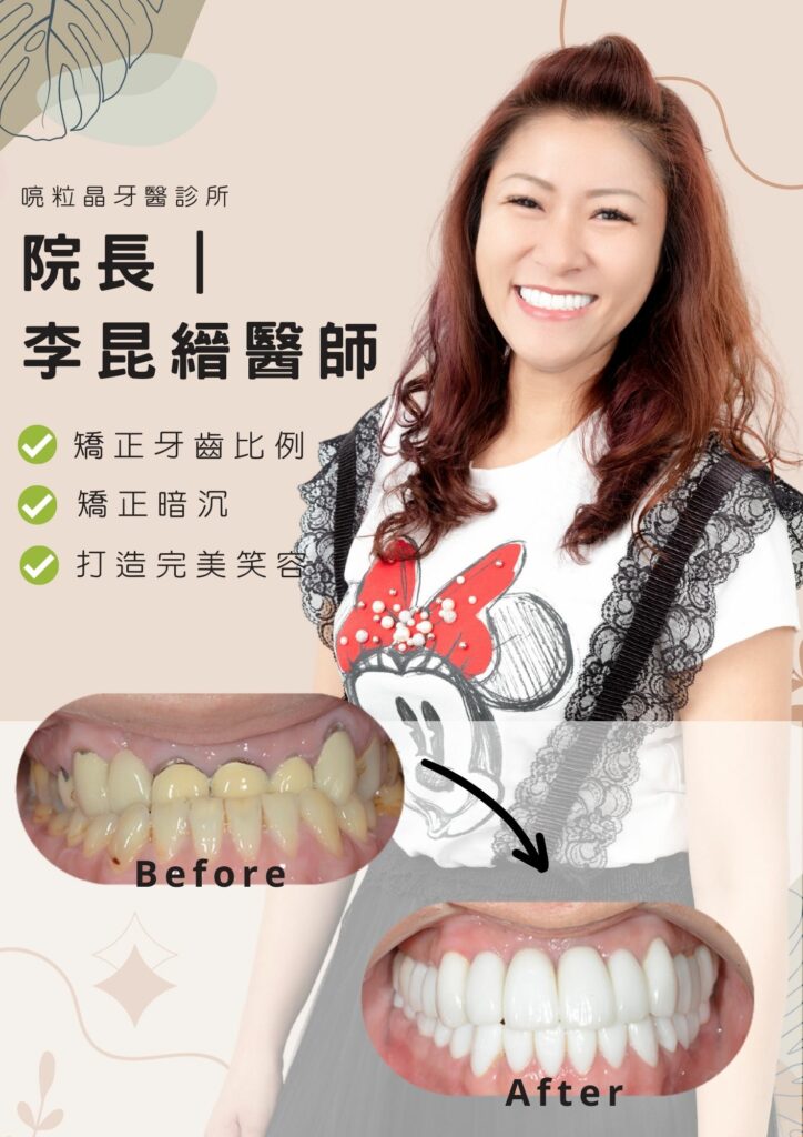 【牙齒美白案例-喨粒晶牙醫診所】矯正牙齒比例，矯正暗沉，打造完美笑容，就交給喨粒晶牙醫