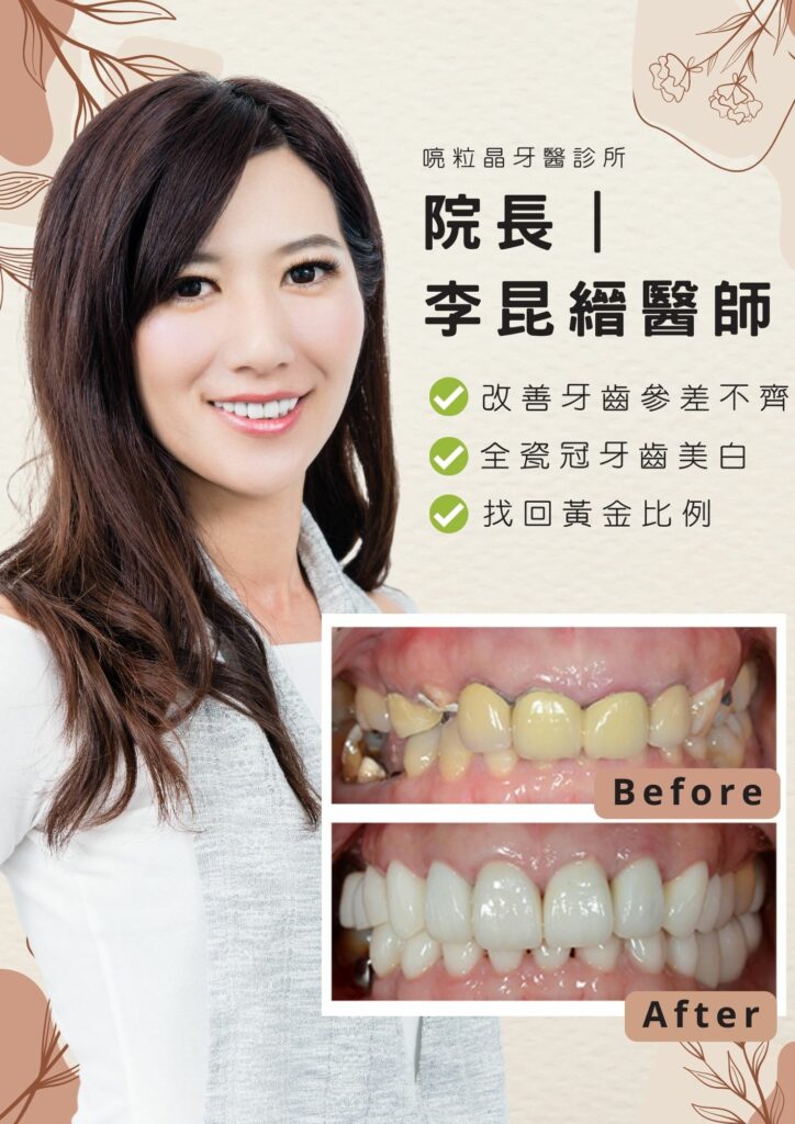【牙齒美白案例-喨粒晶牙醫診所】1.改善牙齒參差不齊2.全瓷冠牙齒美白，找回回金比例，牙齒美白前後對照圖